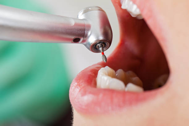 Best Broken or Cracked Tooth Emergency Dentist in New Cumberland, PA